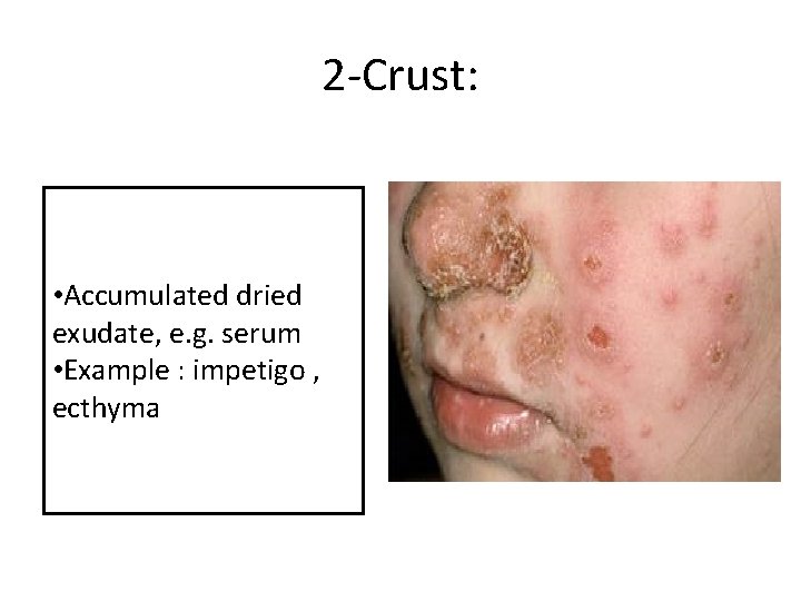 2 -Crust: • Accumulated dried exudate, e. g. serum • Example : impetigo ,