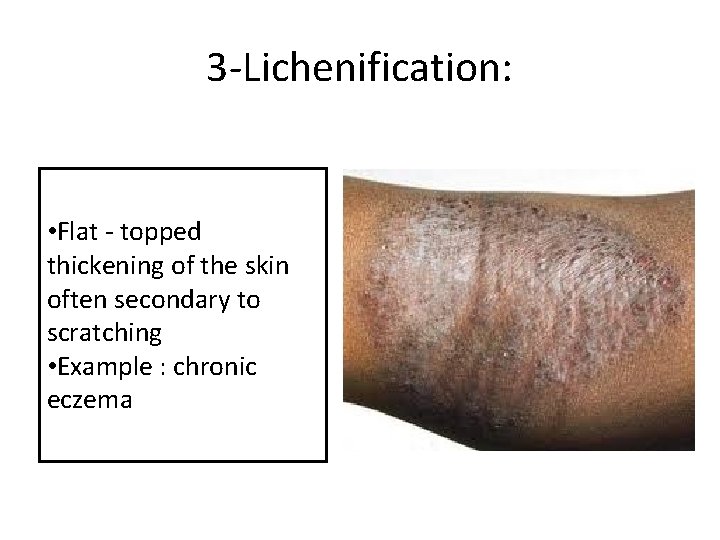 3 -Lichenification: • Flat - topped thickening of the skin often secondary to scratching