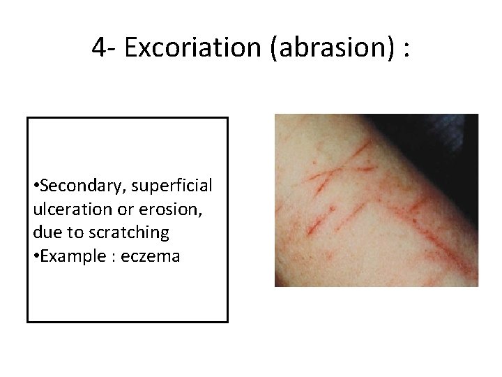 4 - Excoriation (abrasion) : • Secondary, superficial ulceration or erosion, due to scratching