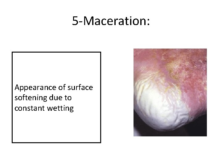 5 -Maceration: Appearance of surface softening due to constant wetting 