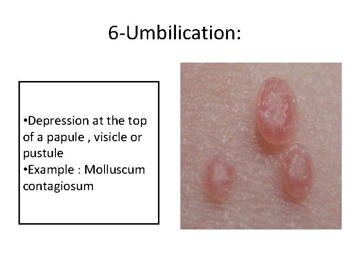 6 -Umbilication: • Depression at the top of a papule , visicle or pustule