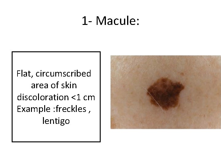 1 - Macule: Flat, circumscribed area of skin discoloration <1 cm Example : freckles