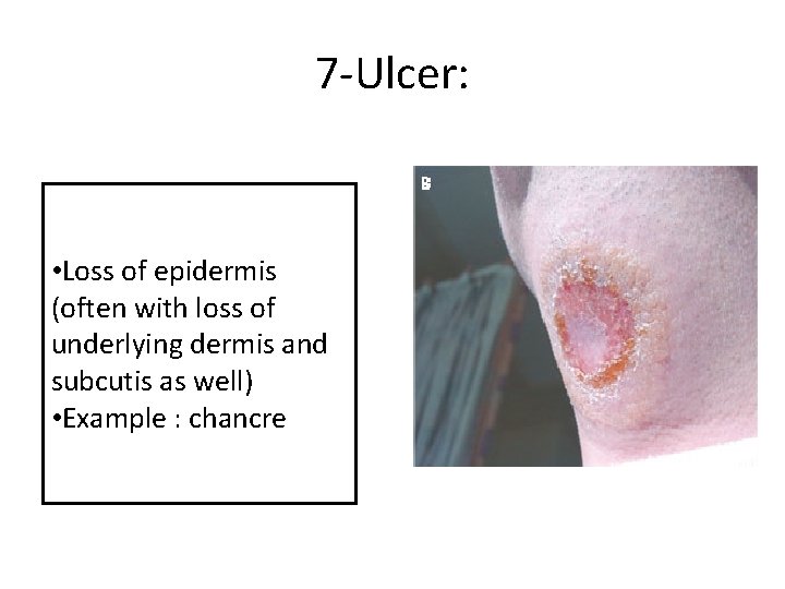 7 -Ulcer: • Loss of epidermis (often with loss of underlying dermis and subcutis