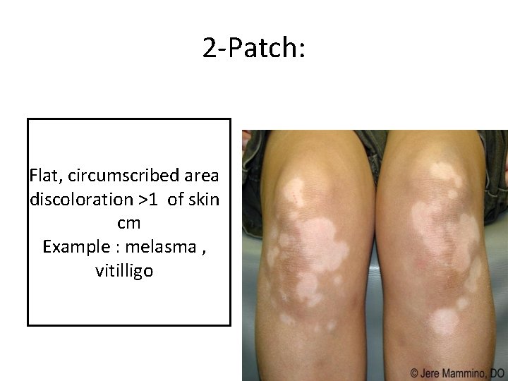 2 -Patch: Flat, circumscribed area discoloration >1 of skin cm Example : melasma ,