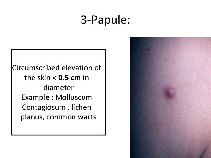 3 -Papule: Circumscribed elevation of the skin < 0. 5 cm in diameter Example