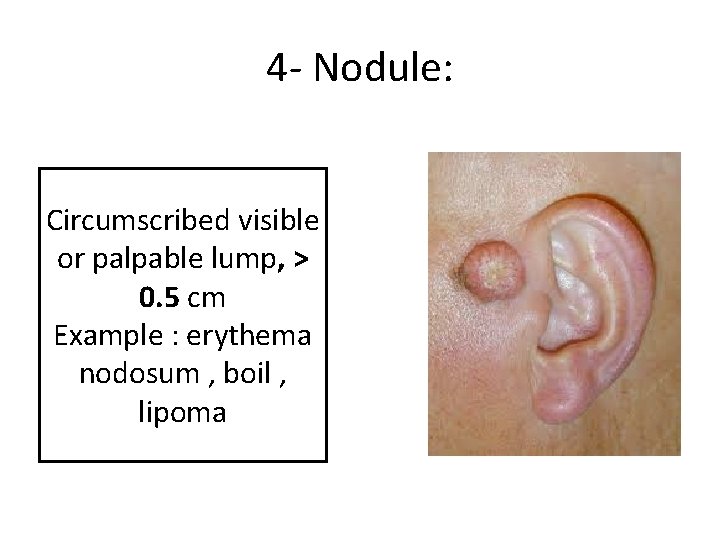 4 - Nodule: Circumscribed visible or palpable lump, > 0. 5 cm Example :