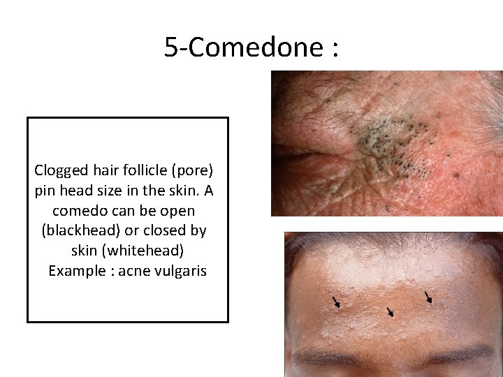 5 -Comedone : Clogged hair follicle (pore) pin head size in the skin. A