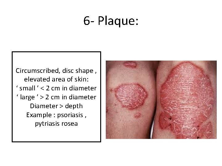 6 - Plaque: Circumscribed, disc shape , elevated area of skin: ‘ small ’