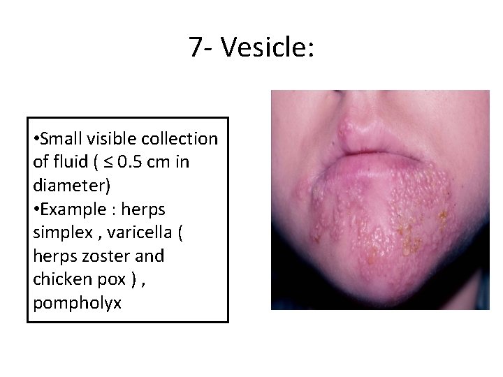 7 - Vesicle: • Small visible collection of fluid ( ≤ 0. 5 cm