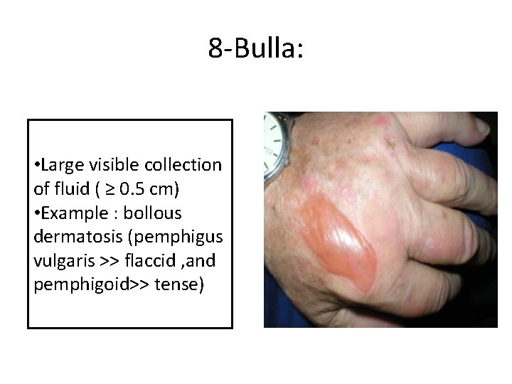 8 -Bulla: • Large visible collection of fluid ( ≥ 0. 5 cm) •