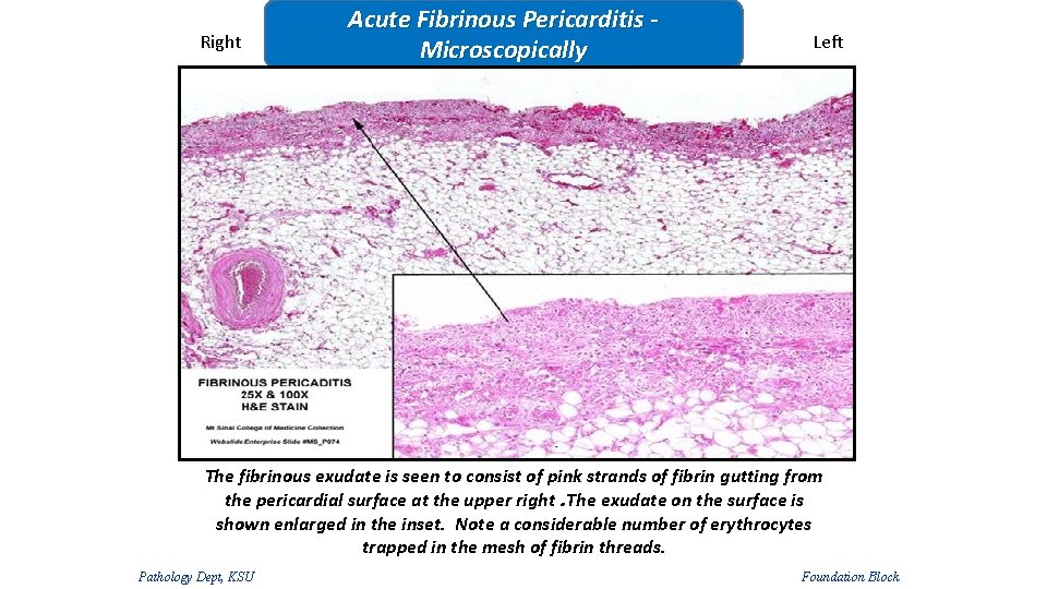 Right Acute Fibrinous Pericarditis Microscopically Left The fibrinous exudate is seen to consist of