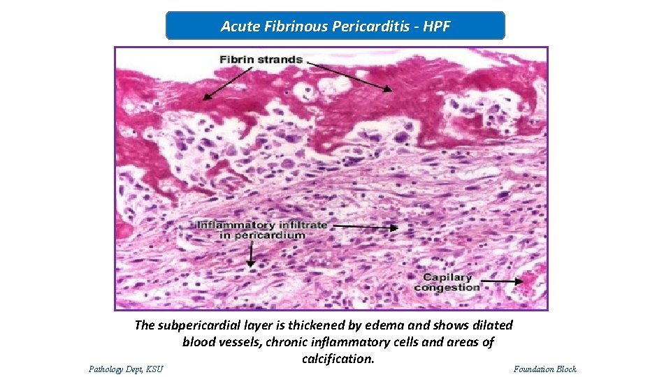 Acute Fibrinous Pericarditis - HPF The subpericardial layer is thickened by edema and shows