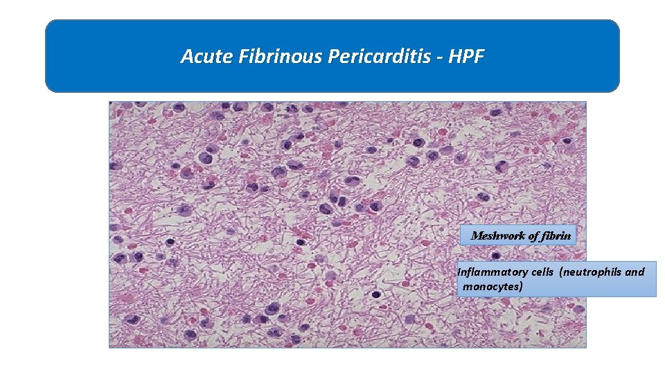 Acute Fibrinous Pericarditis - HPF Meshwork of fibrin Inflammatory cells (neutrophils and monocytes) 