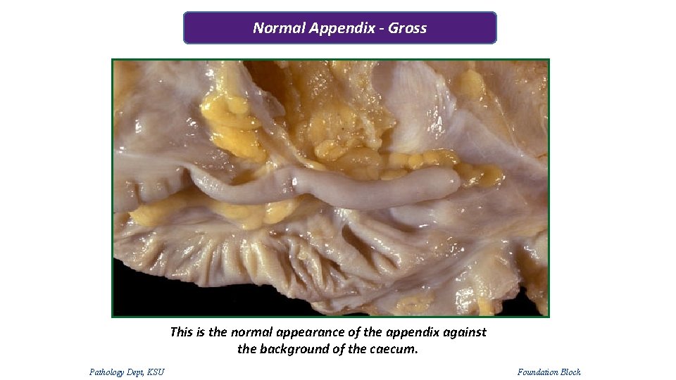 Normal Appendix - Gross This is the normal appearance of the appendix against the