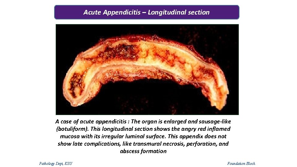 Acute Appendicitis – Longitudinal section A case of acute appendicitis : The organ is