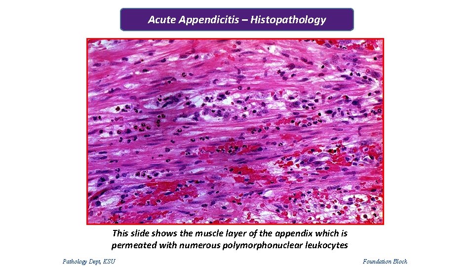 Acute Appendicitis – Histopathology This slide shows the muscle layer of the appendix which