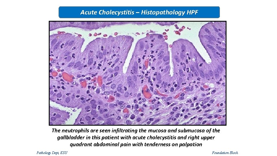 Acute Cholecystitis – Histopathology HPF The neutrophils are seen infiltrating the mucosa and submucosa