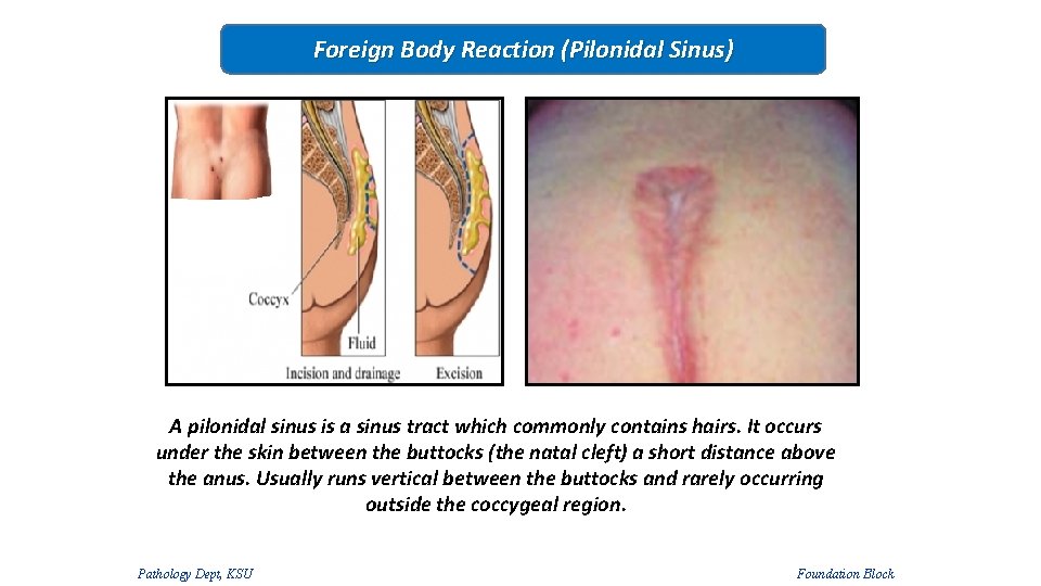 Foreign Body Reaction (Pilonidal Sinus) A pilonidal sinus is a sinus tract which commonly