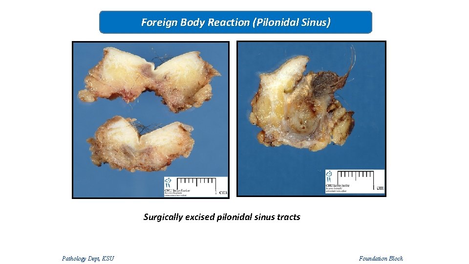 Foreign Body Reaction (Pilonidal Sinus) Surgically excised pilonidal sinus tracts Pathology Dept, KSU Foundation