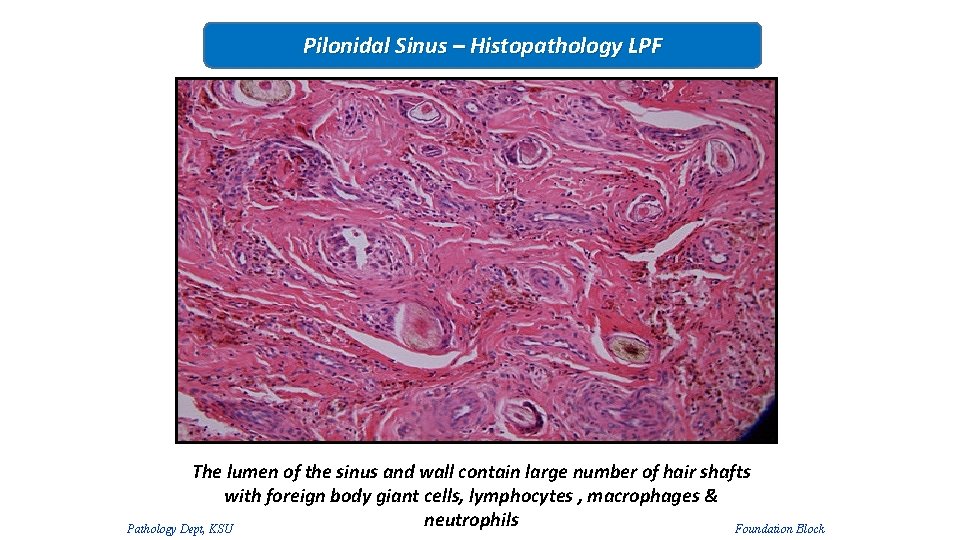 Pilonidal Sinus – Histopathology LPF The lumen of the sinus and wall contain large