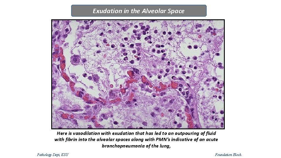 Exudation in the Alveolar Space Here is vasodilation with exudation that has led to