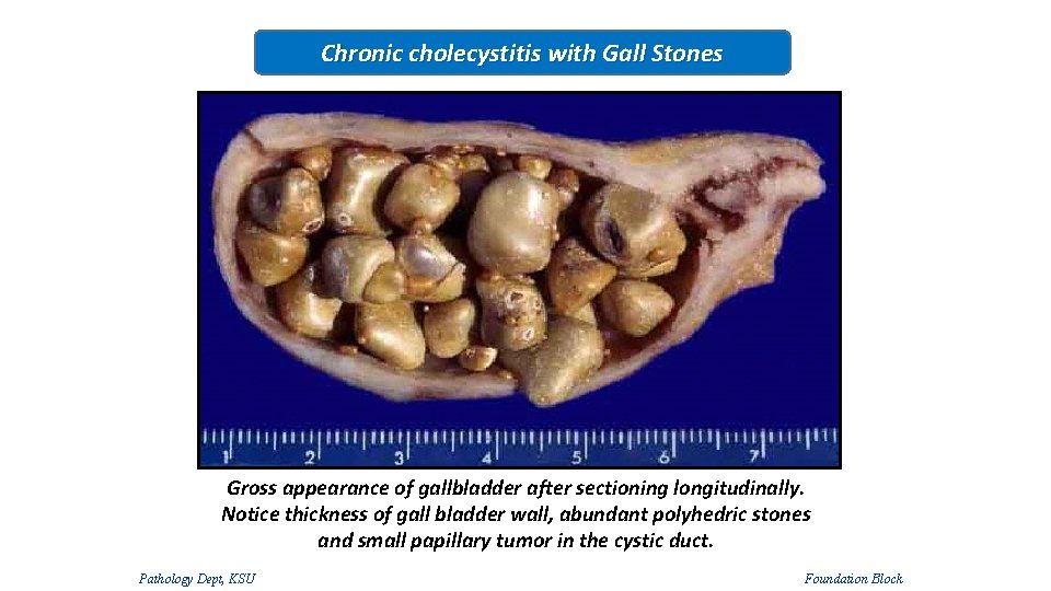 Chronic cholecystitis with Gall Stones Gross appearance of gallbladder after sectioning longitudinally. Notice thickness