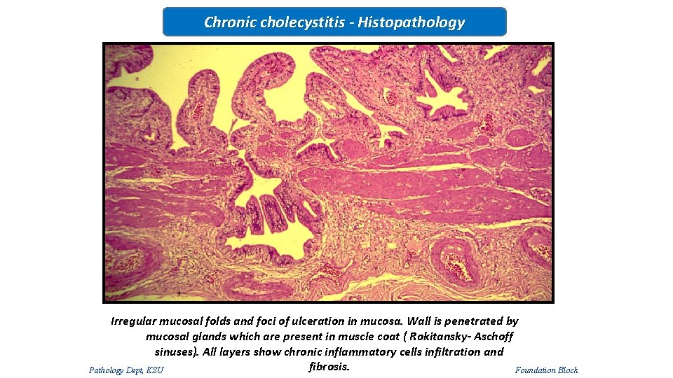 Chronic cholecystitis - Histopathology Irregular mucosal folds and foci of ulceration in mucosa. Wall