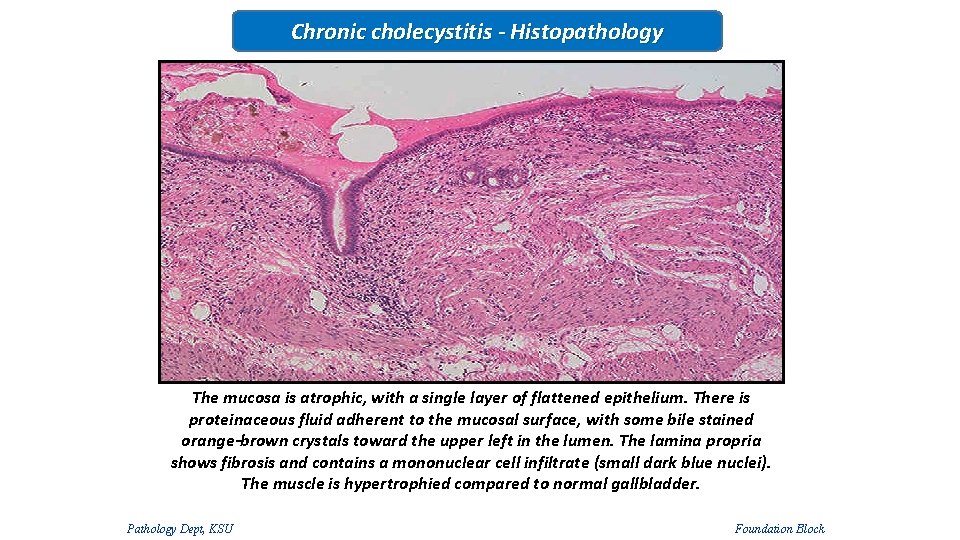 Chronic cholecystitis - Histopathology The mucosa is atrophic, with a single layer of flattened
