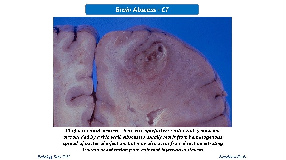 Brain Abscess - CT CT of a cerebral abscess. There is a liquefactive center