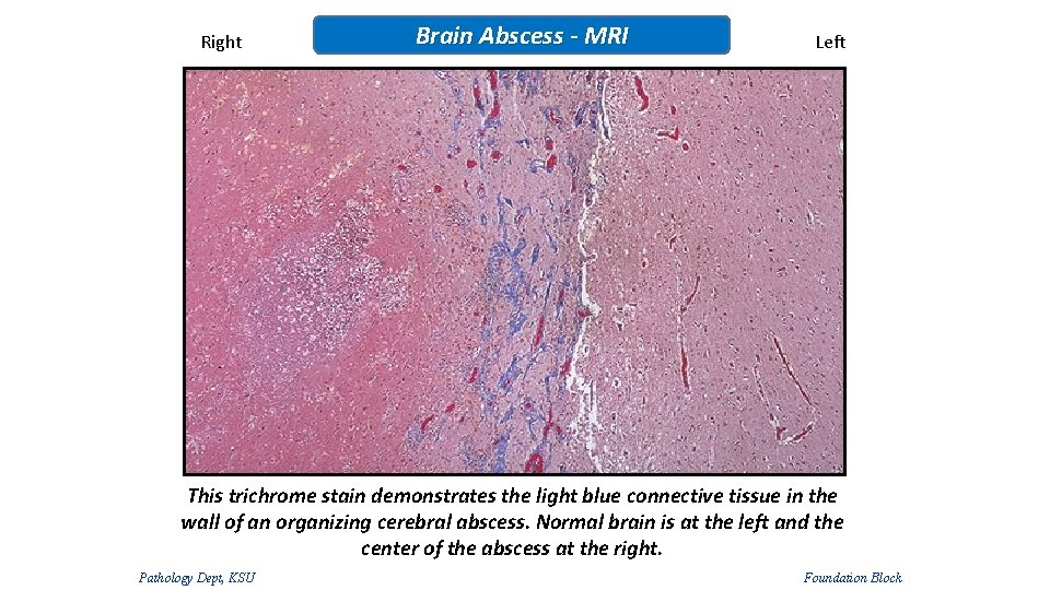 Right Brain Abscess - MRI Left This trichrome stain demonstrates the light blue connective