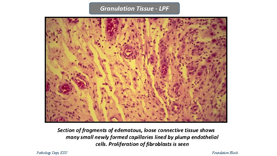 Granulation Tissue - LPF Section of fragments of edematous, loose connective tissue shows many