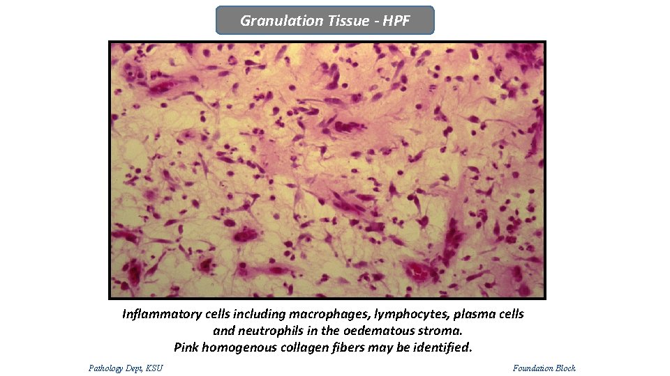 Granulation Tissue - HPF Inflammatory cells including macrophages, lymphocytes, plasma cells and neutrophils in