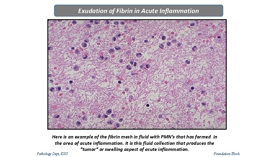 Exudation of Fibrin in Acute Inflammation Here is an example of the fibrin mesh