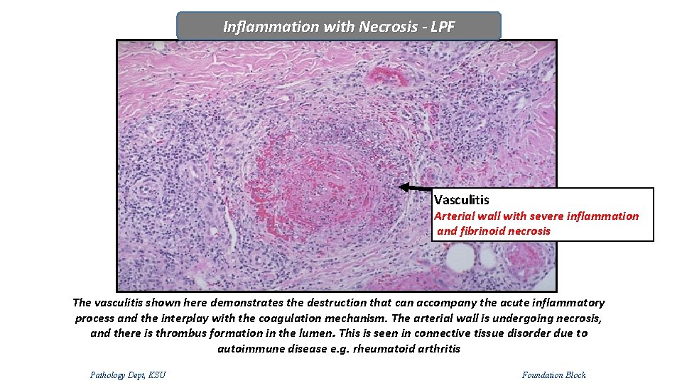 Inflammation with Necrosis - LPF Vasculitis Arterial wall with severe inflammation and fibrinoid necrosis