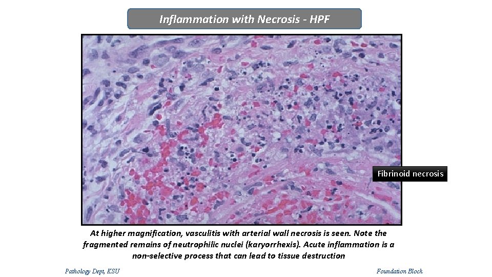 Inflammation with Necrosis - HPF Fibrinoid necrosis At higher magnification, vasculitis with arterial wall