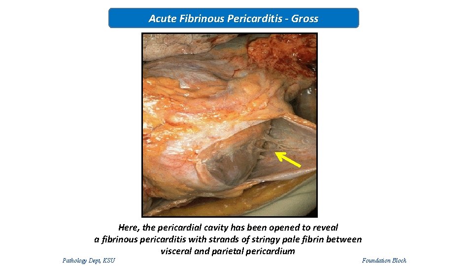 Acute Fibrinous Pericarditis - Gross Here, the pericardial cavity has been opened to reveal