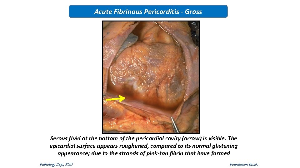 Acute Fibrinous Pericarditis - Gross Serous fluid at the bottom of the pericardial cavity