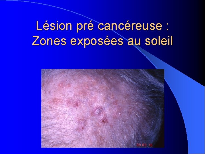 Lésion pré cancéreuse : Zones exposées au soleil 