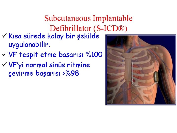 Subcutaneous Implantable Defibrillator (S-ICD®) ü Kısa sürede kolay bir şekilde uygulanabilir. ü VF tespit