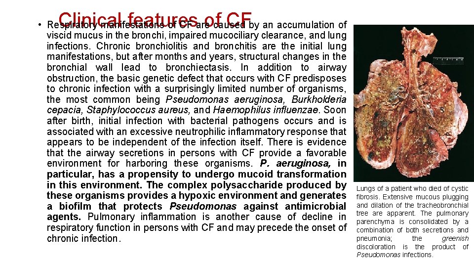 Clinical features of CF • Respiratory manifestations of CF are caused by an accumulation