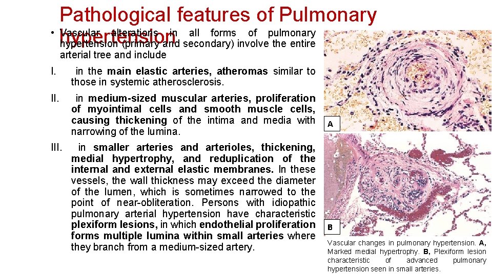 Pathological features of Pulmonary • Vascular alterations in all forms of pulmonary hypertension (primary