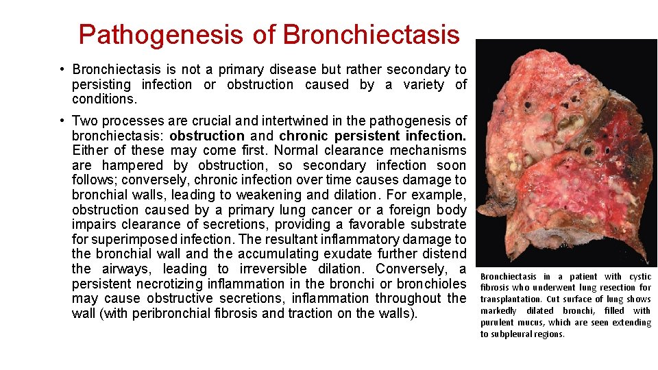 Pathogenesis of Bronchiectasis • Bronchiectasis is not a primary disease but rather secondary to