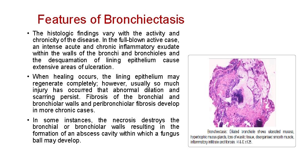 Features of Bronchiectasis • The histologic findings vary with the activity and chronicity of