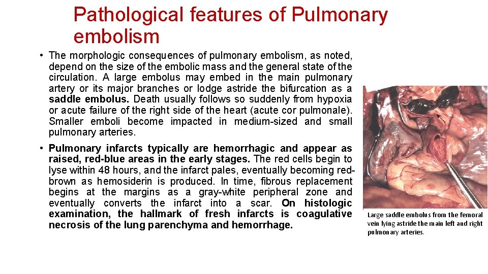 Pathological features of Pulmonary embolism • The morphologic consequences of pulmonary embolism, as noted,