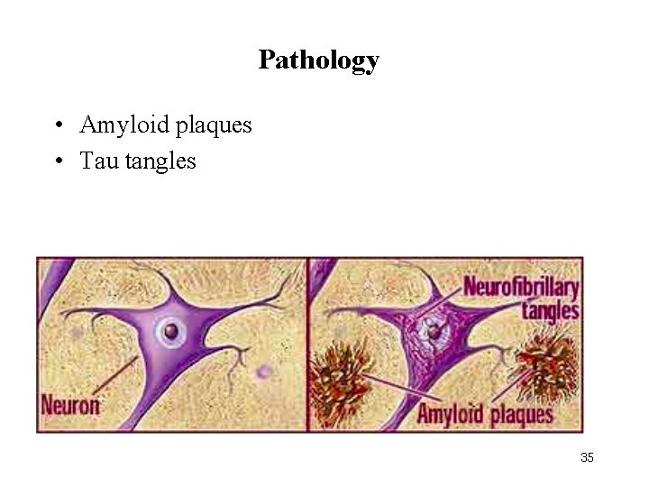 Pathology • Amyloid plaques • Tau tangles 35 