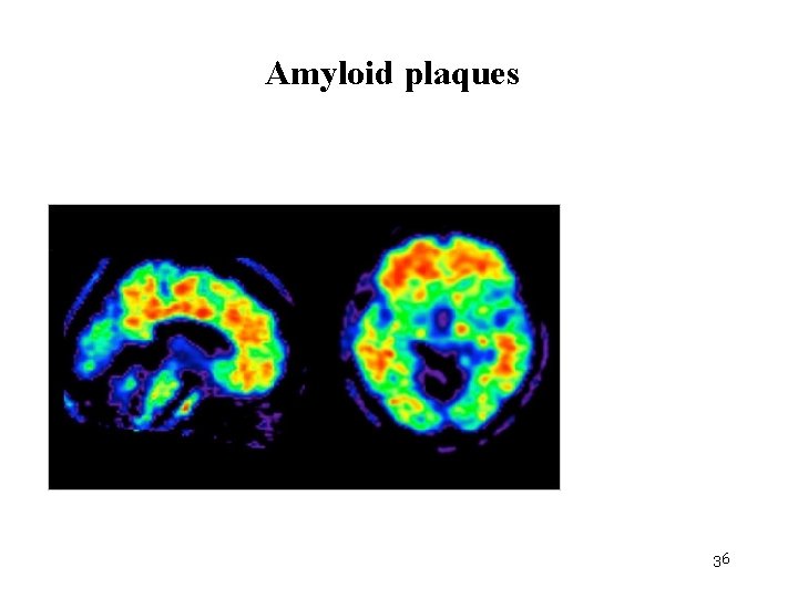Amyloid plaques 36 