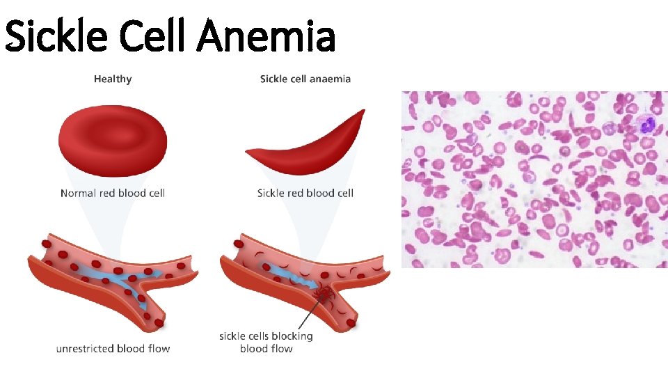 Sickle Cell Anemia 
