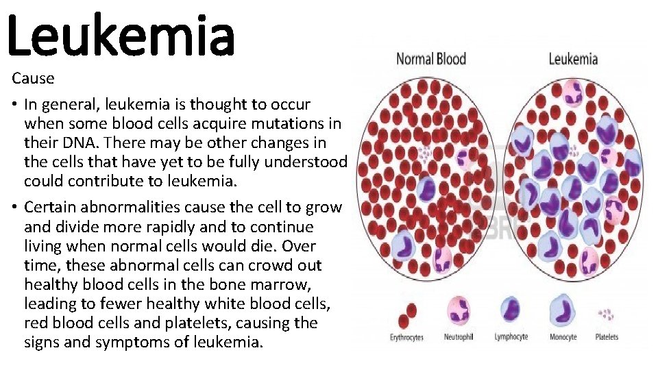 Leukemia Cause • In general, leukemia is thought to occur when some blood cells