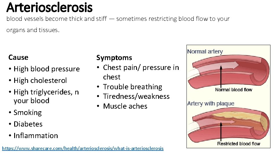 Arteriosclerosis blood vessels become thick and stiff — sometimes restricting blood flow to your