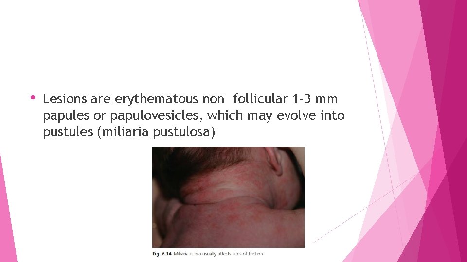  • Lesions are erythematous non follicular 1 -3 mm papules or papulovesicles, which